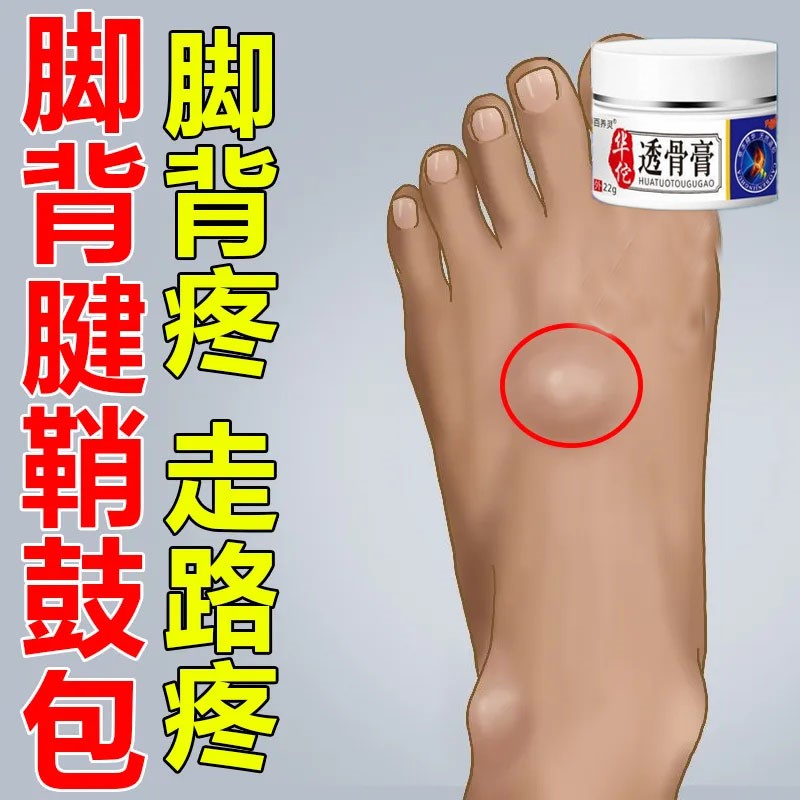 脚背鼓包疼痛专用脚面筋疼腱鞘囊