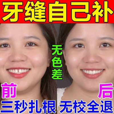 补齿牙补缝牙自己神器填充树