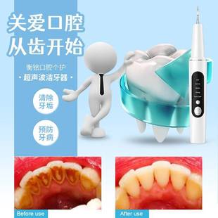 家用清洁黄牙烟渍牙齿美白洁牙仪 洗牙超声波洁牙器机