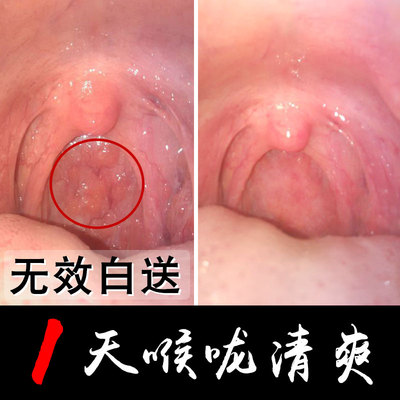 治疗慢性咽炎茶药特效除根神器咽喉炎干痒异物感肿痛喷剂滤泡增生