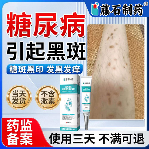 藤石制药糖尿病引起小腿黑斑去糖斑除胫前皮肤痒色素沉着烂足膏xu