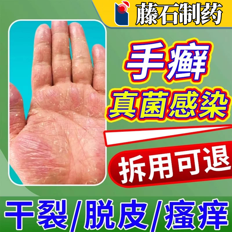 手癣膏脱皮干裂真菌感染手足癣湿疹去止痒藓鹅掌风手气手指xu