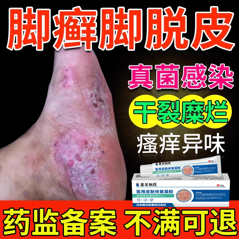 【药监备案】脚癣一次净止痒
