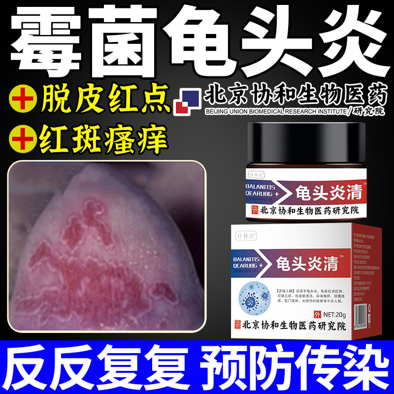 龟头炎症专用软膏霉菌型真菌感染包皮炎龟头上有小红点红肿裂口oa