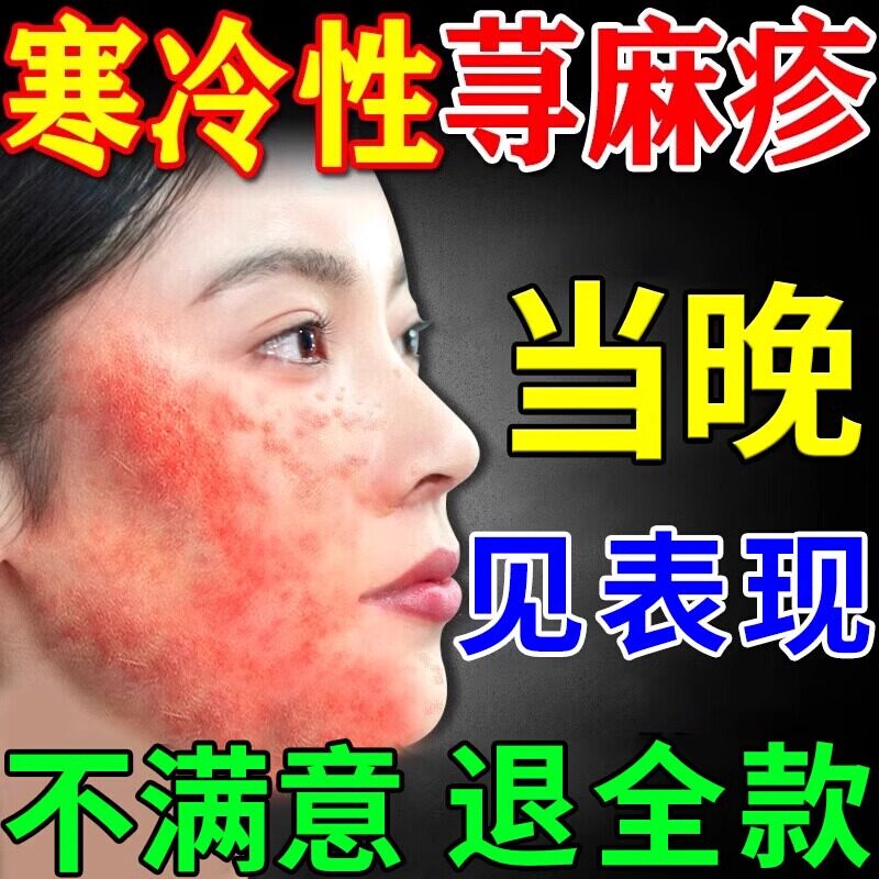 急慢性过敏性胆碱划痕性荨麻疹用