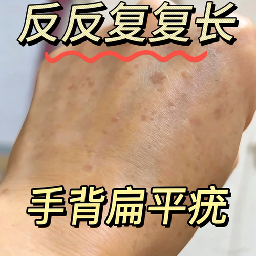 HPV引起手背扁平疣膏神一抹器灵猴子疙瘩尤瘊软膏干扰素凝胶CS