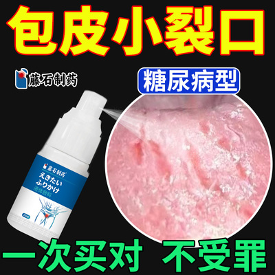 药监备案--糖尿病包皮开裂裂口