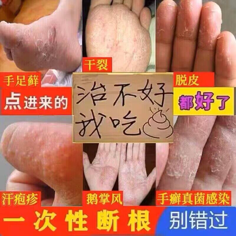 手癣膏脱皮干裂真菌感染手指湿疹止痒去药膏根鹅掌风手上小水泡足