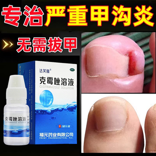 甲沟炎治疗特专用效药膏祛息肉去除嵌甲克脱指甲星刀液软化剂神器
