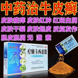 疗癣卡西甫散银屑病口服药内服药牛皮癣体癣痒口服中药ZZ