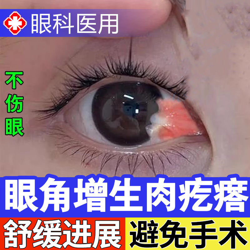 【药监局备案】眼角长胬肉息肉