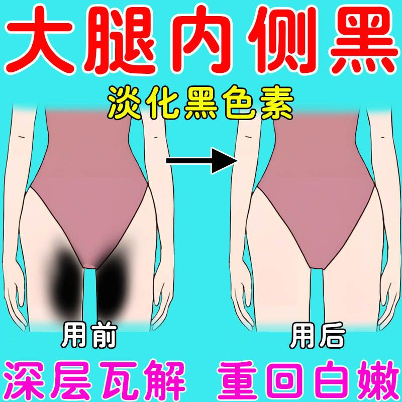 【重回白嫩】大腿内侧黑久坐屁股黑脖子黑肘关节黑淡化黑色素