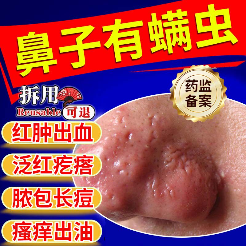 红鼻子去螨虫酒糟鼻玫瑰痤疮专用脸部屏障修复鼻头痒可搭药膏用aa