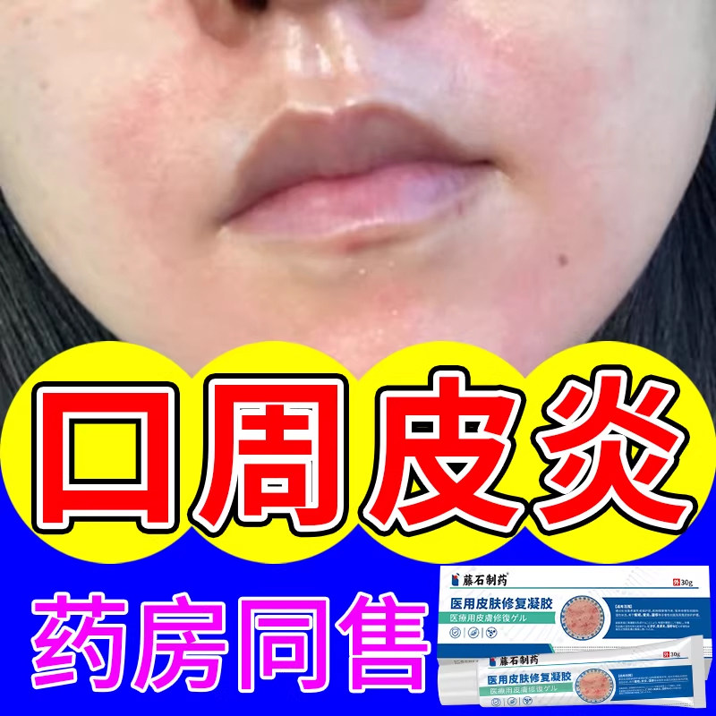 口周皮炎嘴唇嘴巴周围红斑丘疹瘙痒过敏起皮泛红专用唇周炎膏WQ