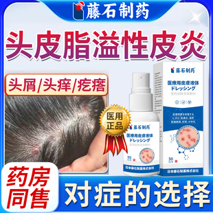 脂溢性皮炎头部喷雾剂头皮屑止痒真菌感染头癣头痒有疙瘩起痤疮WQ