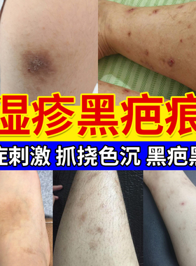 湿疹疤痕淡化黑色素沉淀炎症后色素沉着蚊子包去黑印疤印祛疤膏HT
