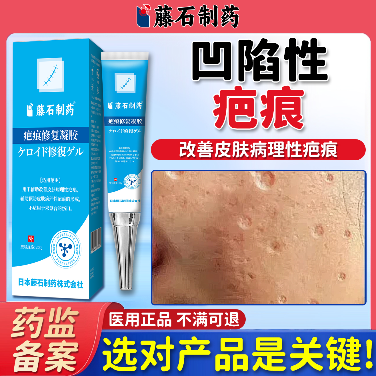 水痘疤痕痘印痘坑凹陷性痘疤