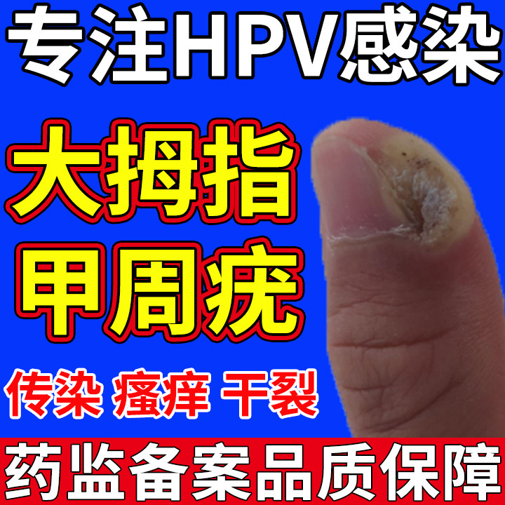 甲周疣手上长疣甲下专用指寻常疣去除神器儿童祛疣灵药房同款膏jh