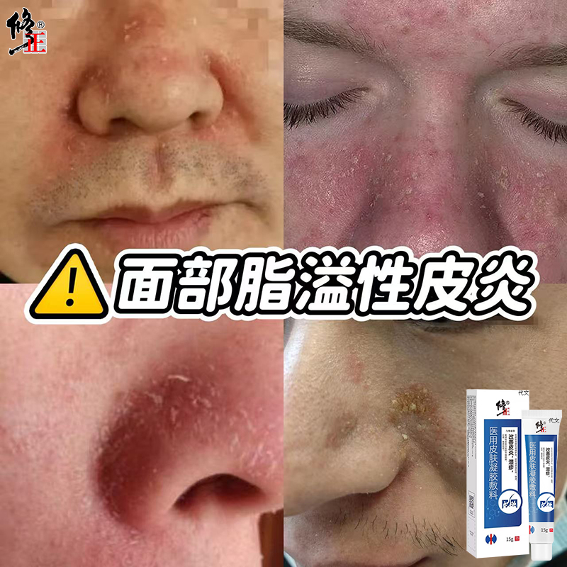 面部脂溢性皮炎--红斑鳞屑油腻