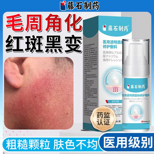 面部毛周角化症儿童小颗粒去除