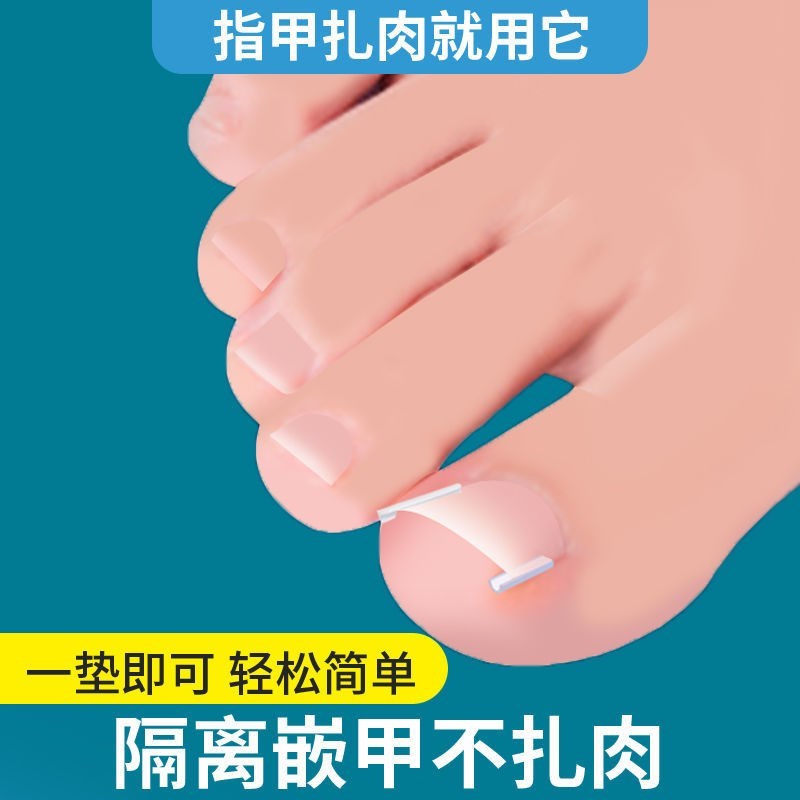 正甲扣甲沟矫正指甲往肉里张长条隔离垫片预防甲炎嵌甲不扎脚神器