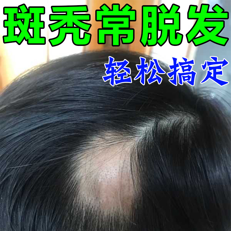 鬼剃头斑秃脱发严重女士增发密发斑脱男士专用防脱育发剂