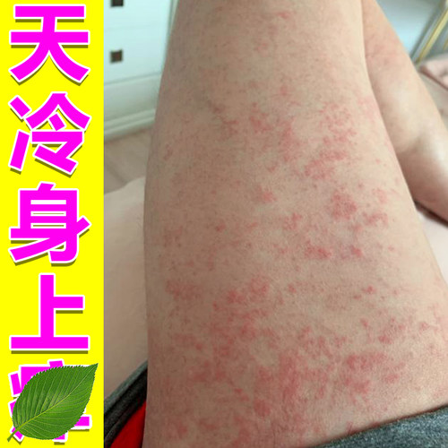 皮肤粗糙痒外用软膏腿上小红疙瘩春季