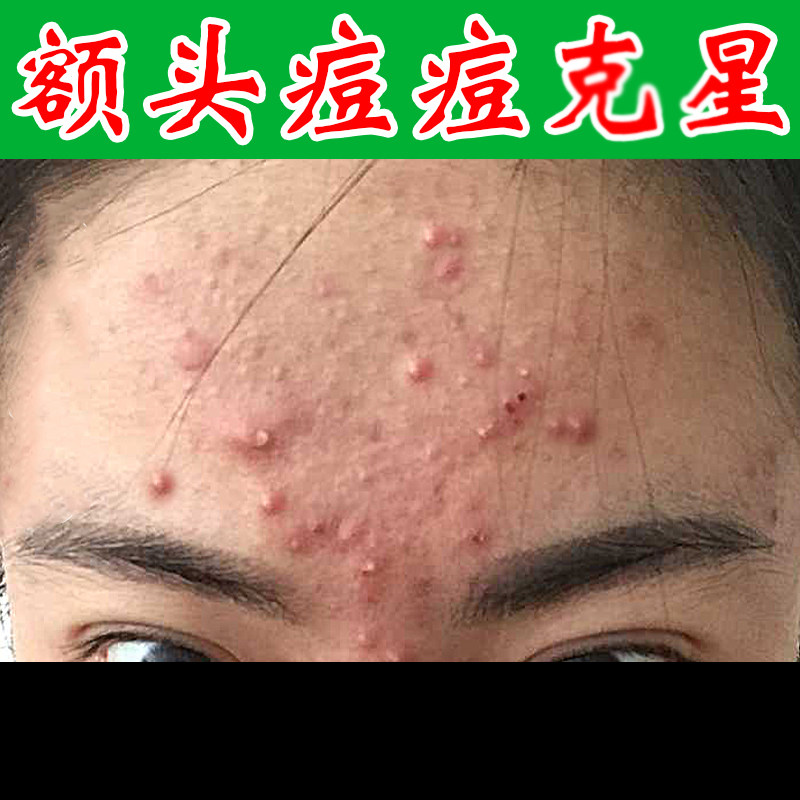 额头痘下巴痘脸上反复长痘粉刺男女学生外用青春痘软膏