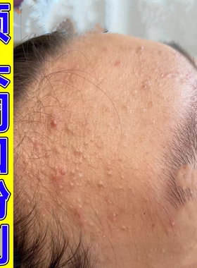 额头上长小疙瘩油性皮肤头部闭口疙瘩粉刺修复痘坑软膏