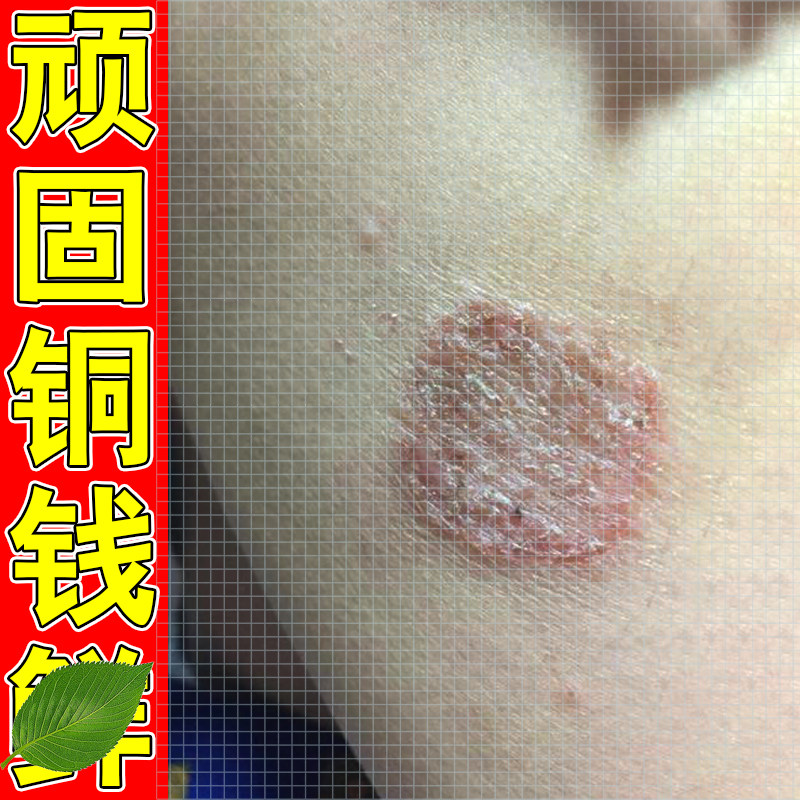 去顽固铜钱鲜体鲜专用膏皮肤干燥脱屑外用