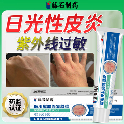 日光性皮炎紫外线过敏皮肤发痒