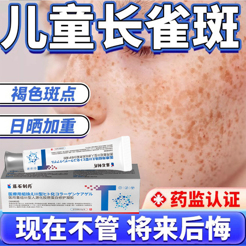 儿童脸上长雀斑色素沉积