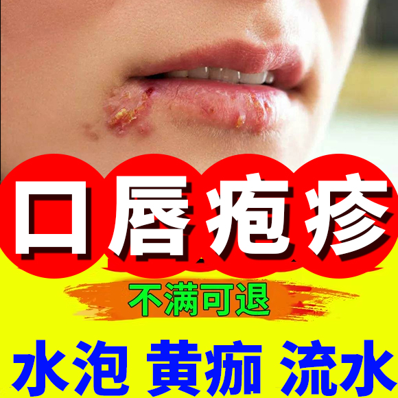 嘴巴上火起泡水泡烂嘴角口唇嘴唇鼻子长疱疹开裂凝胶可搭配药膏to