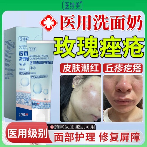 玫瑰痤疮洗面奶---医用级别