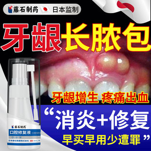 牙龈脓包肿痛消炎专用喷雾剂药房同款治牙根发炎肿包肿痛增生YZ