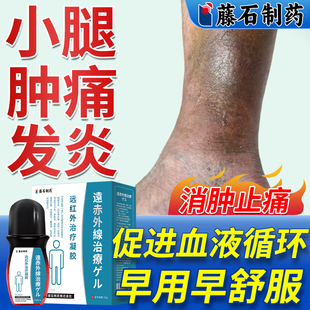 静脉曲张小腿发黑色素沉着脉管炎下肢静脉血栓药房同售膏喷雾剂WQ