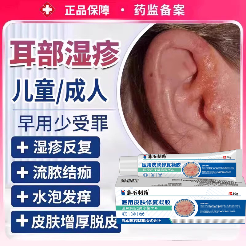 医用级别耳朵皮炎湿疹止痒膏