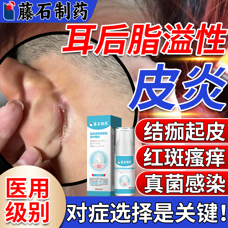 耳后脂溢性皮炎起皮结痂癣耳朵后面湿疹痒外耳道真菌感染专用膏VQ