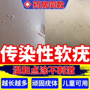 传染性软疣儿童水猴子祛除软疣医用镊子夹扁平疣丝状药房同售膏DS