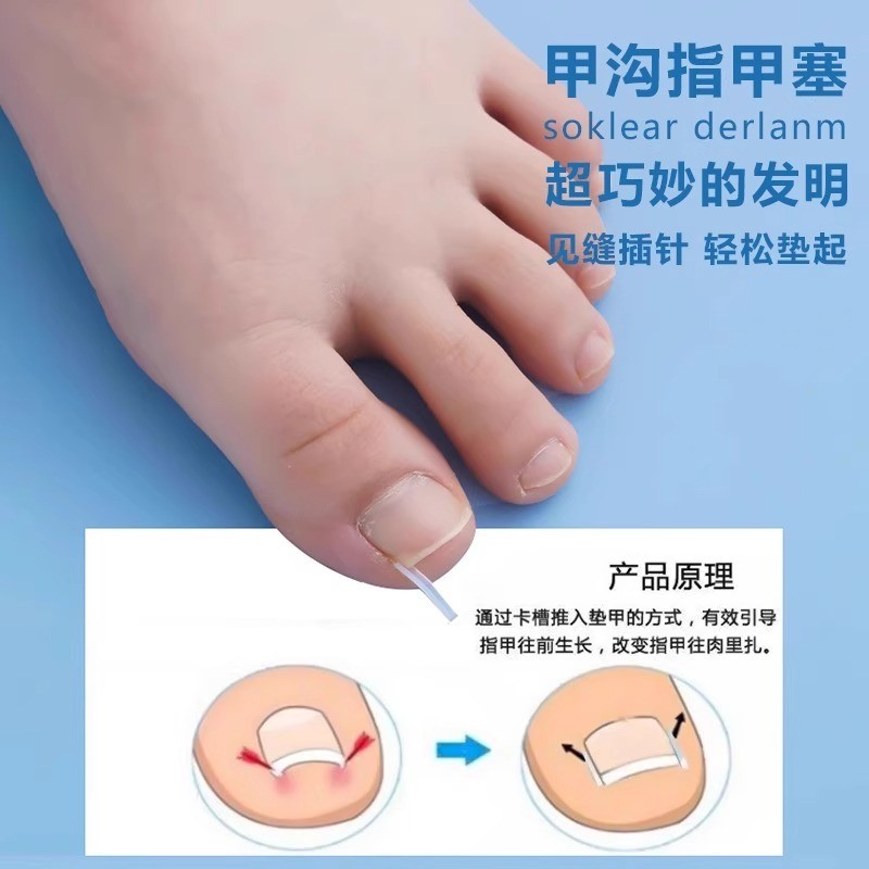 甲沟矫正器正甲贴指甲贴嵌甲专用脚趾甲往肉里长纠正隔离填充垫片