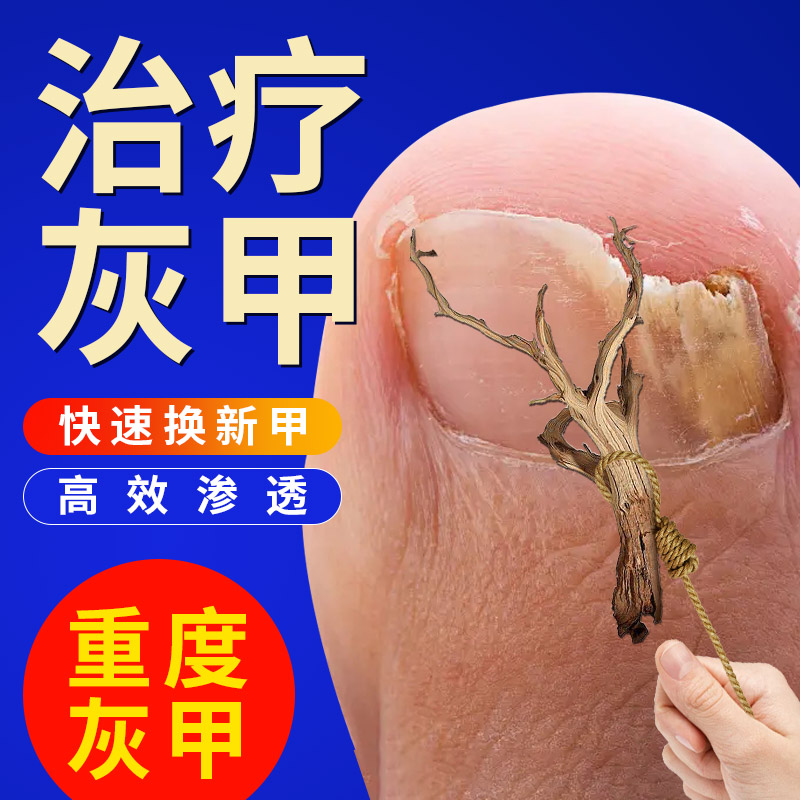 灰指甲治疗专用药正品旗舰店根非甲沟炎药水非亮甲阿莫罗芬搽剂dc