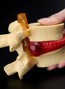 Anatomical Spine Lumbar Disc Herniation Anatomy Teaching Too