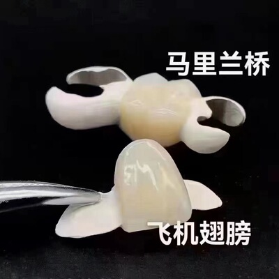 马里兰桥HPP粘结桥拔牙缺牙种植牙老人假牙缺失牙活动全瓷牙套