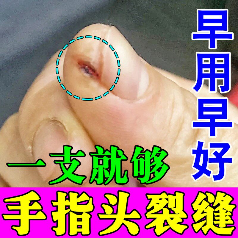 手指裂口干裂修复霜指甲边缘裂口子开裂指尖大拇指粗糙起皮防开裂
