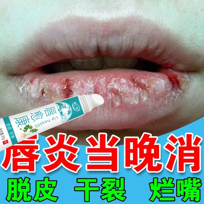 云南本草唇愈膏唇炎唇膏嘴唇干裂疱疹脱皮起泡烂嘴角消肿红痒修复