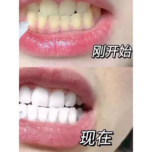 涂白牙齿去黄去黑洗白牙斑净去牙渍神器去牙垢祛除牙菌斑