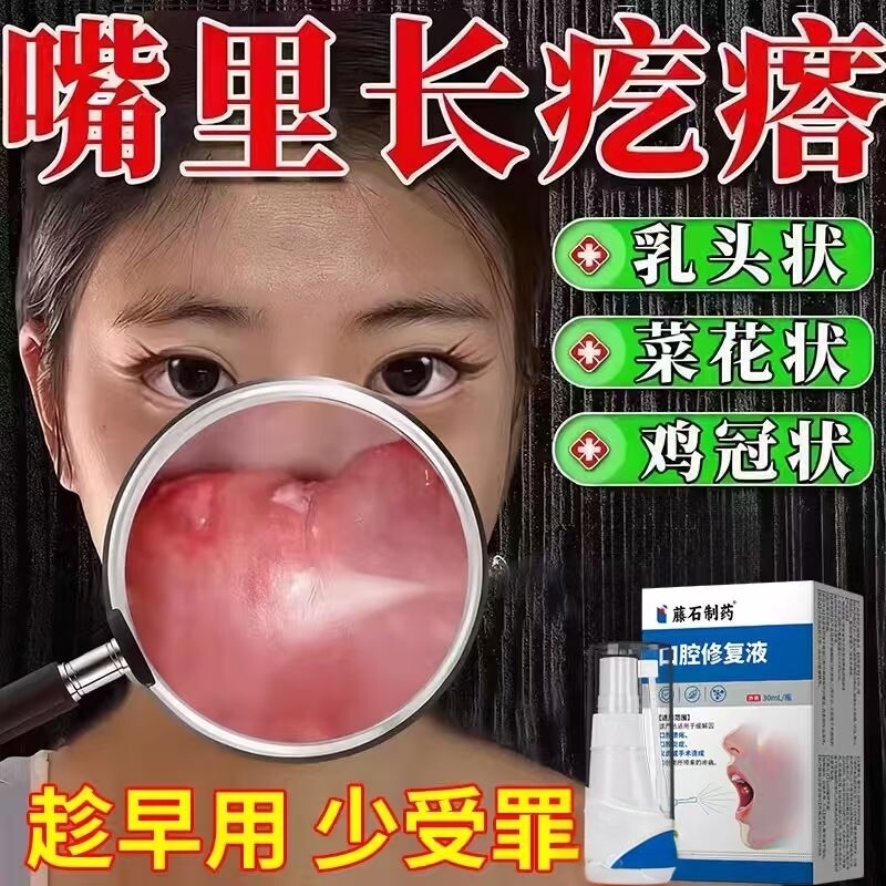 药房同售口腔尖锐湿疣嘴里长肉疙瘩hpv抗病毒专用漱口水干扰素CA