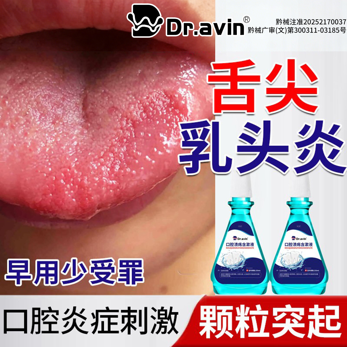 舌乳头炎舌头上火舌尖长疙瘩颗粒增生红点疼痛溃疡裂舌炎漱口水SK