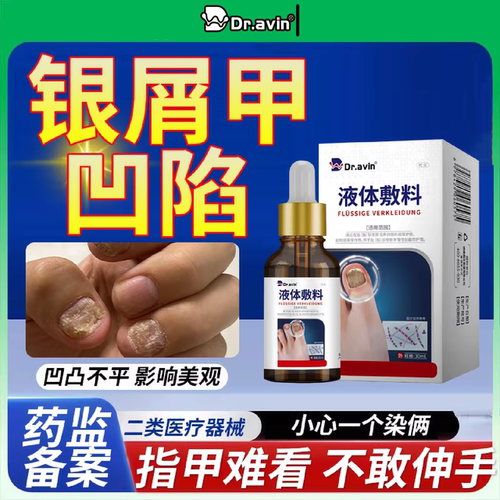 银屑病灰指甲变白增厚真菌感染指甲上有小凹陷凹凸不平液PG