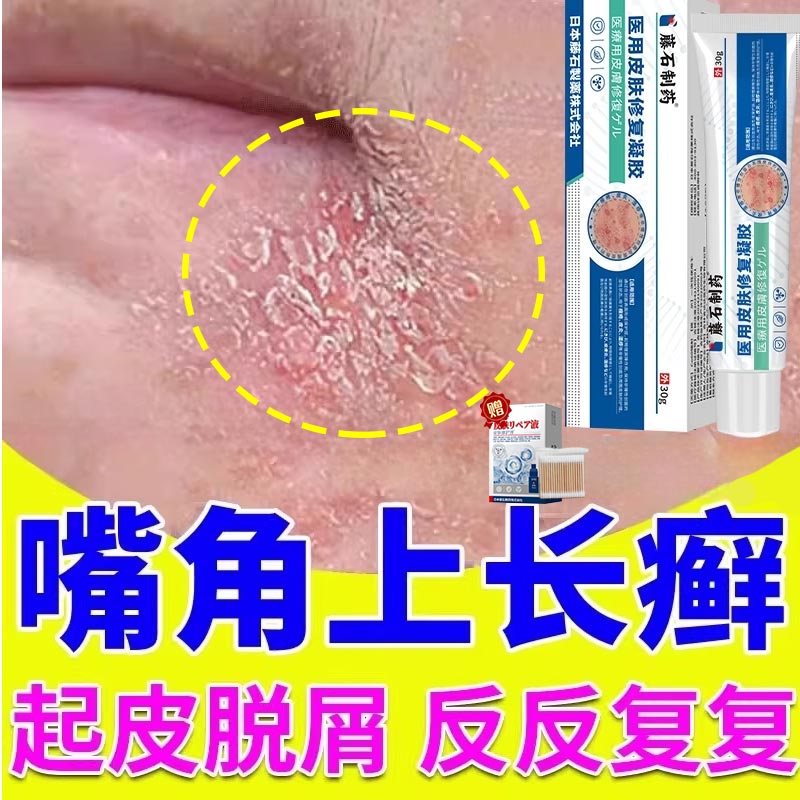 嘴角口周脸上长癣干燥起皮有碎屑泛红脱皮药房同售膏脂溢性皮炎QK